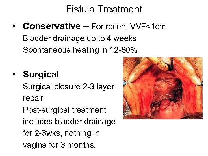 Fistula Treatment • Conservative – For recent VVF<1 cm Bladder drainage up to 4