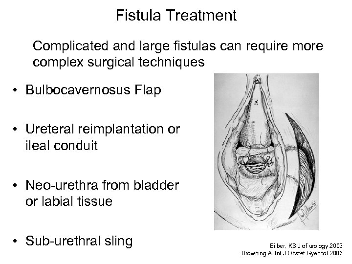 Fistula Treatment Complicated and large fistulas can require more complex surgical techniques • Bulbocavernosus