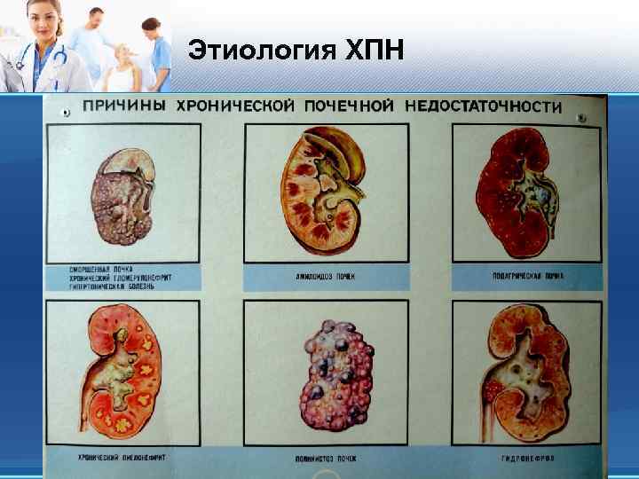 Хроническая почечная недостаточность картинки