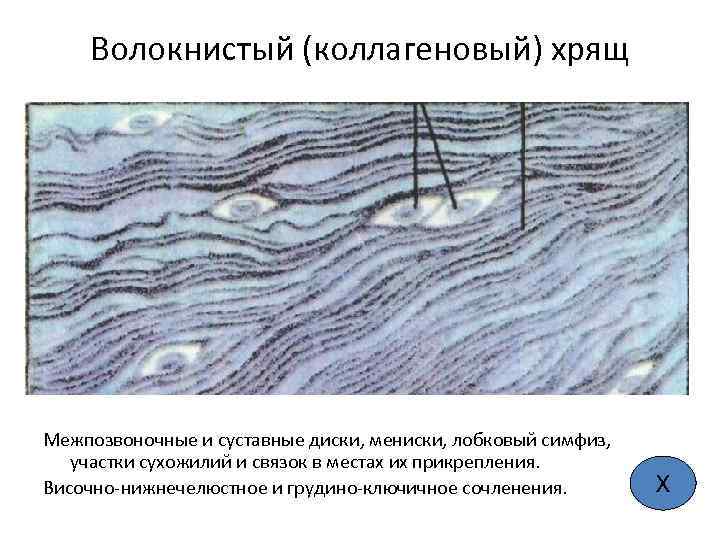 Волокнистый (коллагеновый) хрящ Межпозвоночные и суставные диски, мениски, лобковый симфиз, участки сухожилий и связок