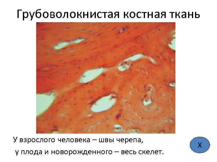 Грубоволокнистая костная ткань У взрослого человека – швы черепа, у плода и новорожденного –