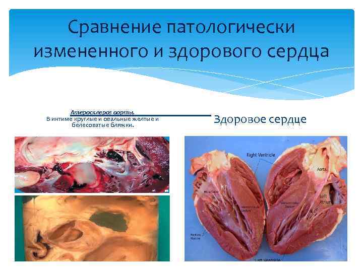 Сравнение патологически измененного и здорового сердца Атеросклероз аорты. В интиме круглые и овальные желтые