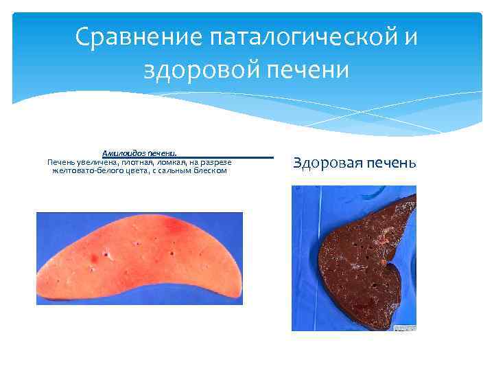 Сравнение паталогической и здоровой печени Амилоидоз печени. Печень увеличена, плотная, ломкая, на разрезе желтовато-белого