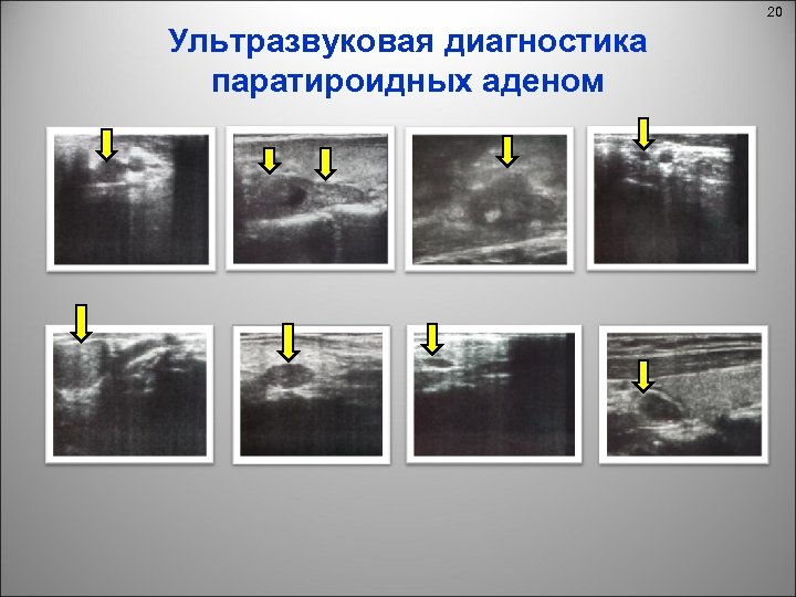 Гиперплазия паращитовидной железы. Паращитовидные железы на УЗИ норма. Гиперплазия паращитовидной железы на УЗИ.