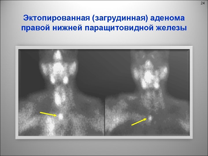 24 Эктопированная (загрудинная) аденома правой нижней паращитовидной железы 