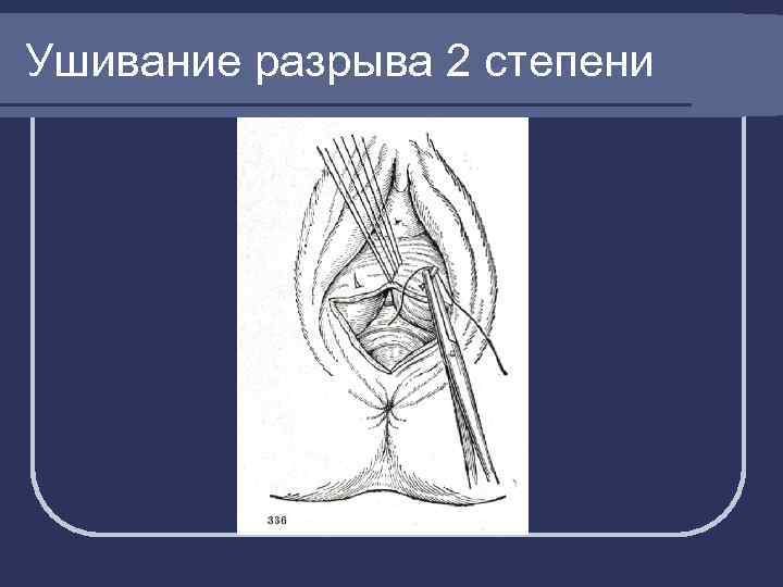Ушивание разрыва 2 степени 