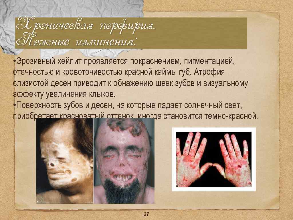 Хроническая порфирия. Кожные изминения: • Эрозивный хейлит проявляется покраснением, пигментацией, отечностью и кровоточивостью красной