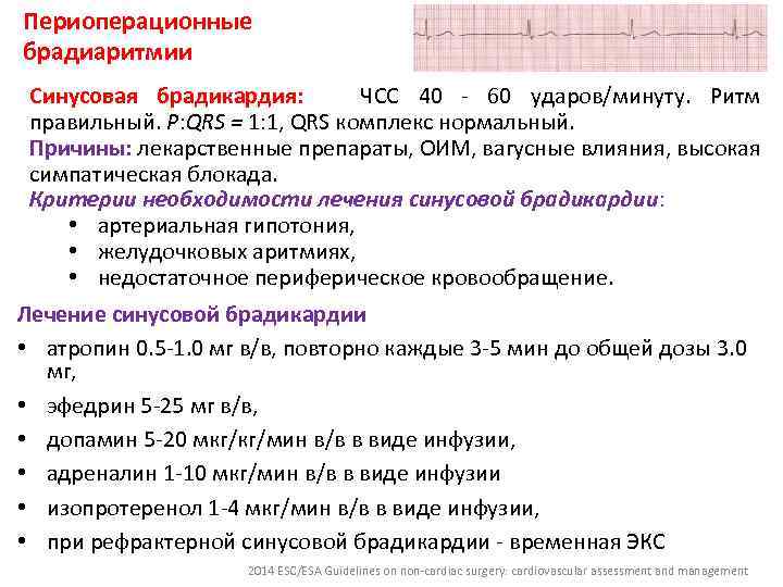 Периоперационные брадиаритмии Синусовая брадикардия: ЧСС 40 - 60 ударов/минуту. Ритм правильный. P: QRS =