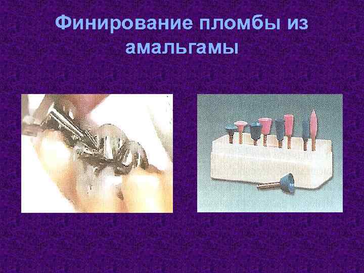 Финирование пломбы из амальгамы 