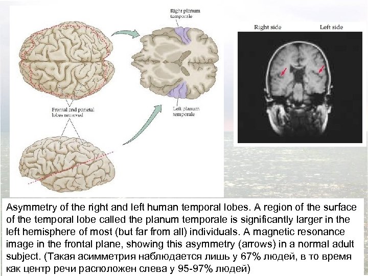 Asymmetry of the right and left human temporal lobes. A region of the surface