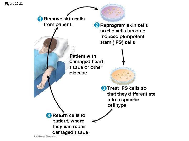 Figure 20. 22 1 Remove skin cells from patient. 2 Reprogram skin cells so