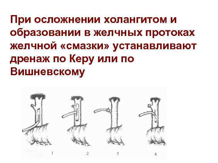 При осложнении холангитом и образовании в желчных протоках желчной «смазки» устанавливают дренаж по Керу