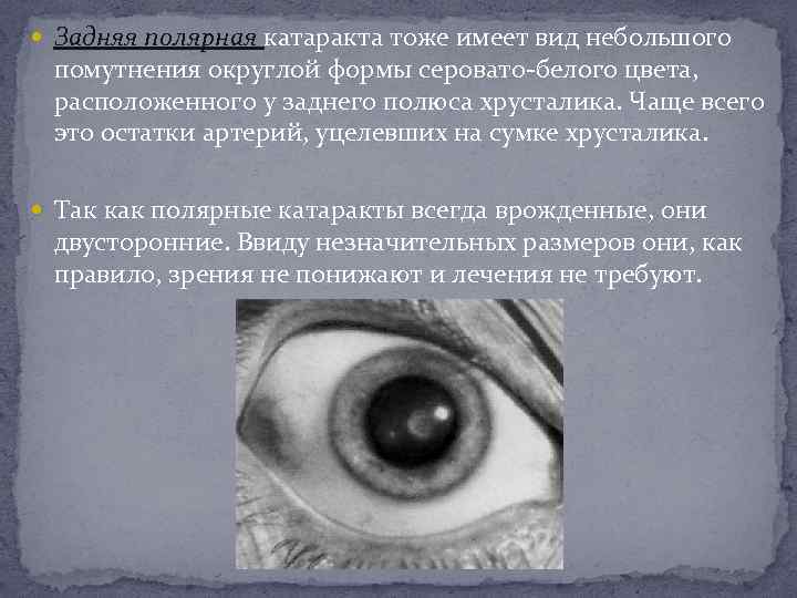  Задняя полярная катаракта тоже имеет вид небольшого помутнения округлой формы серовато-белого цвета, расположенного