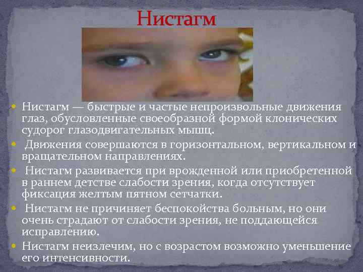 Нистагм глазных яблок