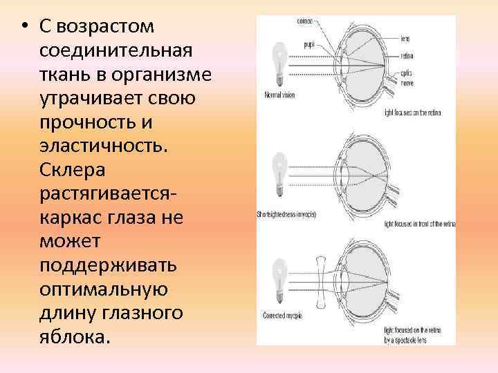  • С возрастом соединительная ткань в организме утрачивает свою прочность и эластичность. Склера