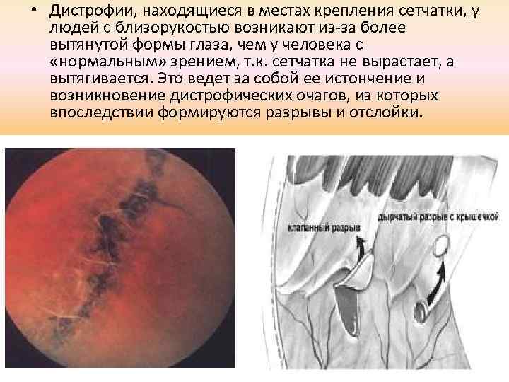  • Дистрофии, находящиеся в местах крепления сетчатки, у людей с близорукостью возникают из-за