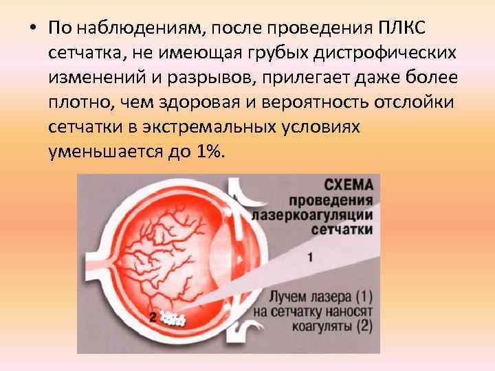  • По наблюдениям, после проведения ПЛКС сетчатка, не имеющая грубых дистрофических изменений и