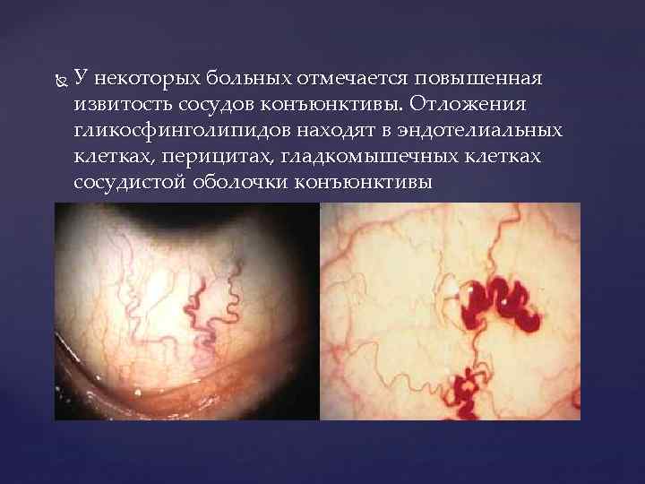  У некоторых больных отмечается повышенная извитость сосудов конъюнктивы. Отложения гликосфинголипидов находят в эндотелиальных