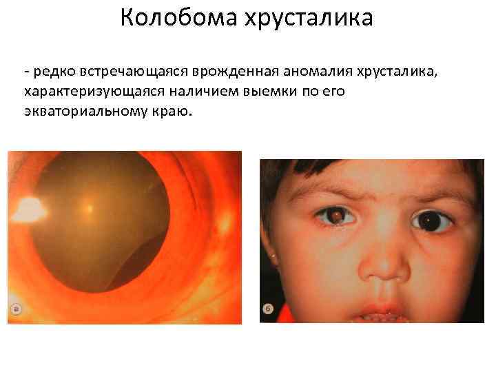 Колобома хрусталика - редко встречающаяся врожденная аномалия хрусталика, характеризующаяся наличием выемки по его экваториальному