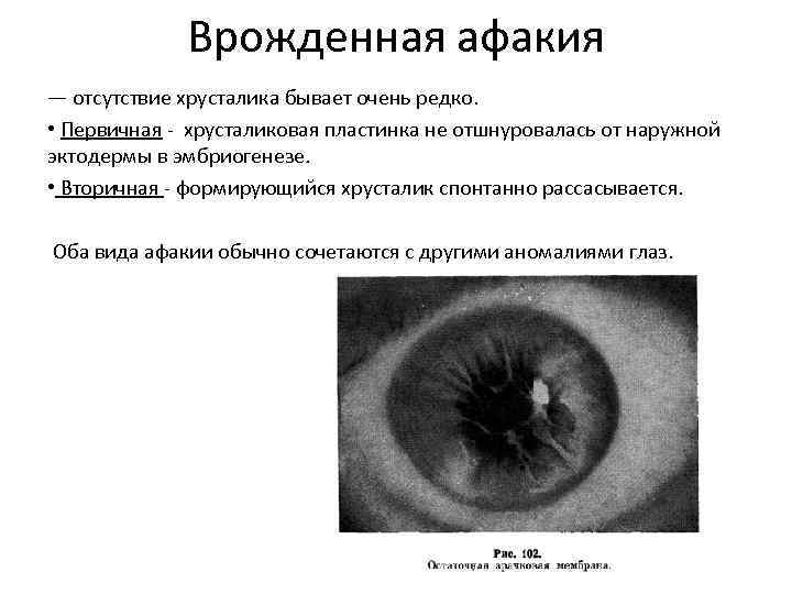 Врожденная афакия — отсутствие хрусталика бывает очень редко. • Первичная - хрусталиковая пластинка не