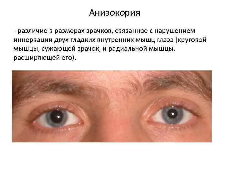 Анизокория - различие в размерах зрачков, связанное с нарушением иннервации двух гладких внутренних мышц