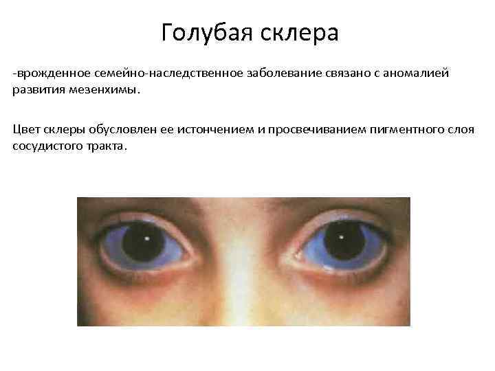 Наследственные заболевания зрения. Склера роговица аномалия. Наследственные заболевания глаз.