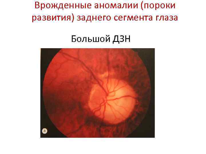 Врожденные аномалии (пороки развития) заднего сегмента глаза Большой ДЗН 