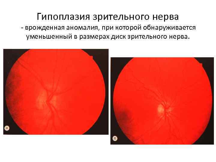 Аномалия развития зрительного нерва. Врожденная пигментация диска зрительного нерва. Аплазия диска зрительного нерва. Аномалии развития зрительного нерва.