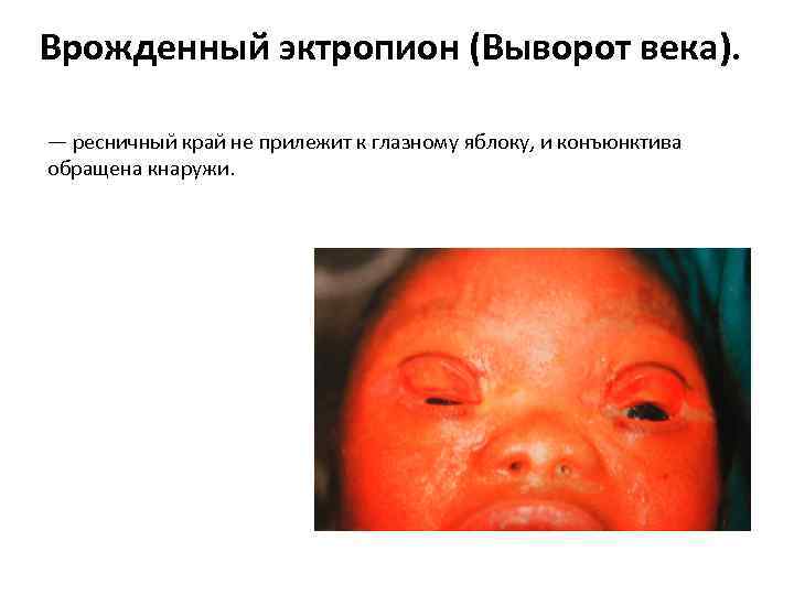 Врожденный эктропион (Выворот века). — ресничный край не прилежит к глазному яблоку, и конъюнктива