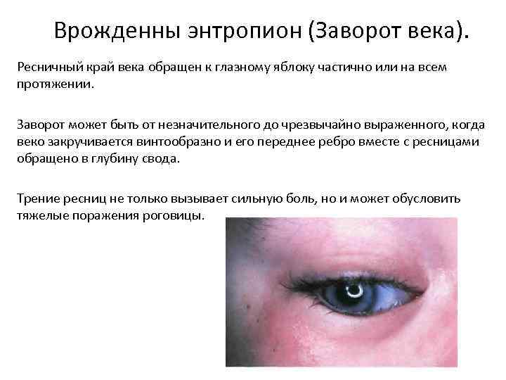 Врожденны энтропион (Заворот века). Ресничный край века обращен к глазному яблоку частично или на