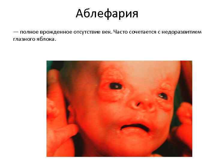 Аблефария — полное врожденное отсутствие век. Часто сочетается с недоразвитием глазного яблока. 