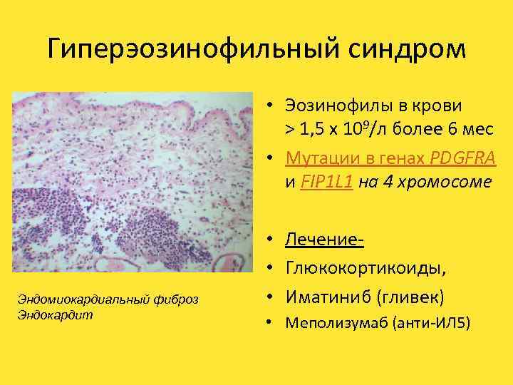 Гиперэозинофильный синдром • Эозинофилы в крови > 1, 5 x 109/л более 6 мес