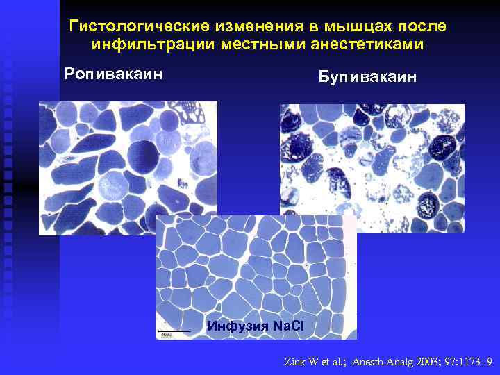 Гистологические изменения в мышцах после инфильтрации местными анестетиками Ропивакаин Бупивакаин Инфузия Na. Cl Zink
