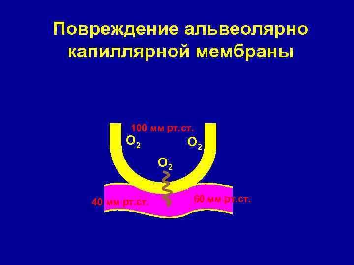 Повреждение альвеолярно капиллярной мембраны 100 мм рт. ст. О 2 О 2 40 мм