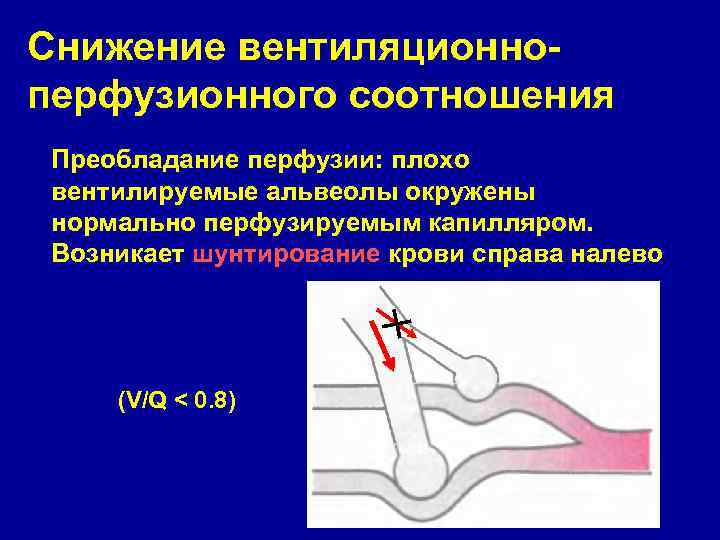 Снижение вентиляционноперфузионного соотношения Преобладание перфузии: плохо вентилируемые альвеолы окружены нормально перфузируемым капилляром. Возникает шунтирование