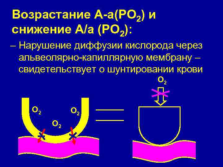 Возрастание А-а(РО 2) и снижение А/а (РО 2): – Нарушение диффузии кислорода через альвеолярно-капиллярную