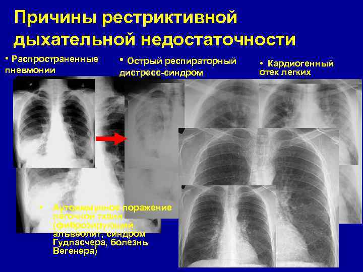 Причины рестриктивной дыхательной недостаточности • Распространенные пневмонии • • Острый респираторный дистресс-синдром Аутоиммунное поражение