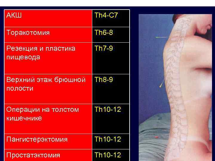 АКШ Th 4 -C 7 Торакотомия Th 6 -8 Резекция и пластика пищевода Th