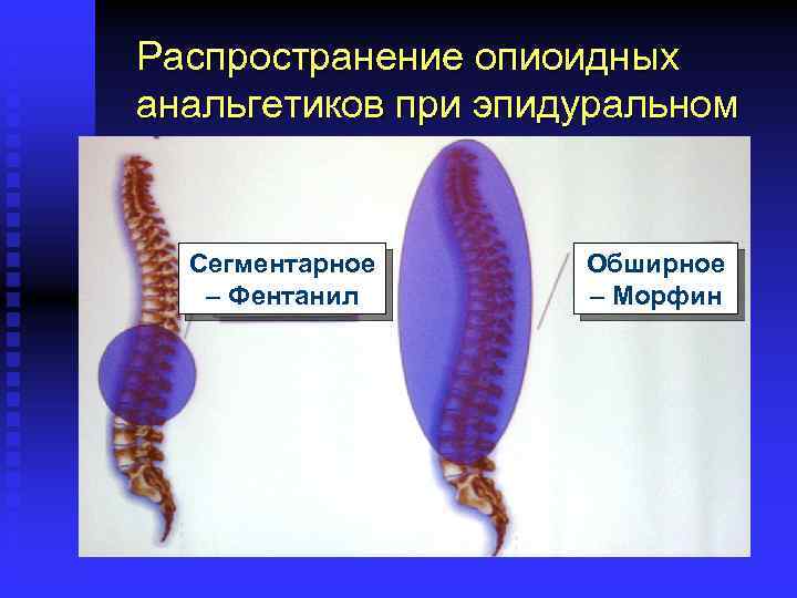 Распространение опиоидных анальгетиков при эпидуральном введении Сегментарное – Фентанил Обширное – Морфин 