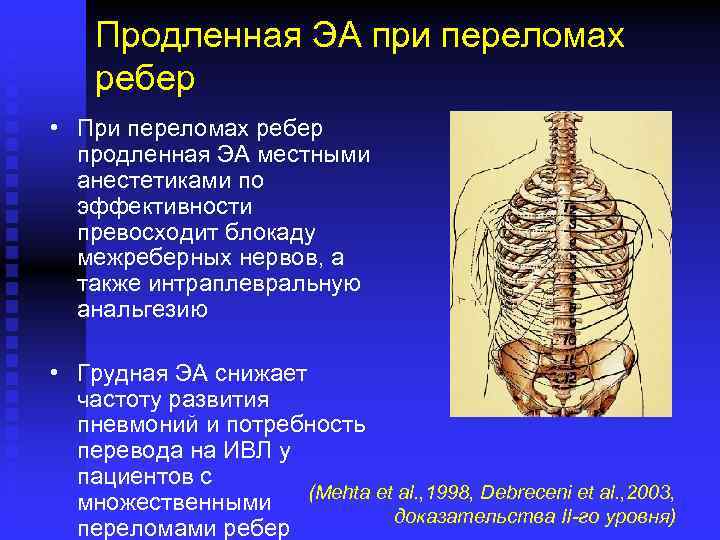 Продленная ЭА при переломах ребер • При переломах ребер продленная ЭА местными анестетиками по