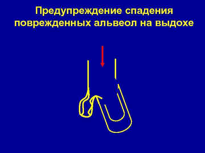 Предупреждение спадения поврежденных альвеол на выдохе 