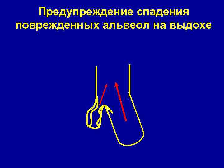 Предупреждение спадения поврежденных альвеол на выдохе 