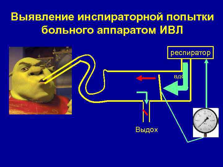 Выявление инспираторной попытки больного аппаратом ИВЛ респиратор вдох Выдох 