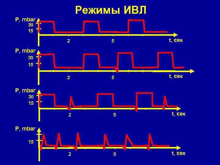 Режимы ИВЛ P, mbar 30 15 2 5 t, сек P, mbar 15 
