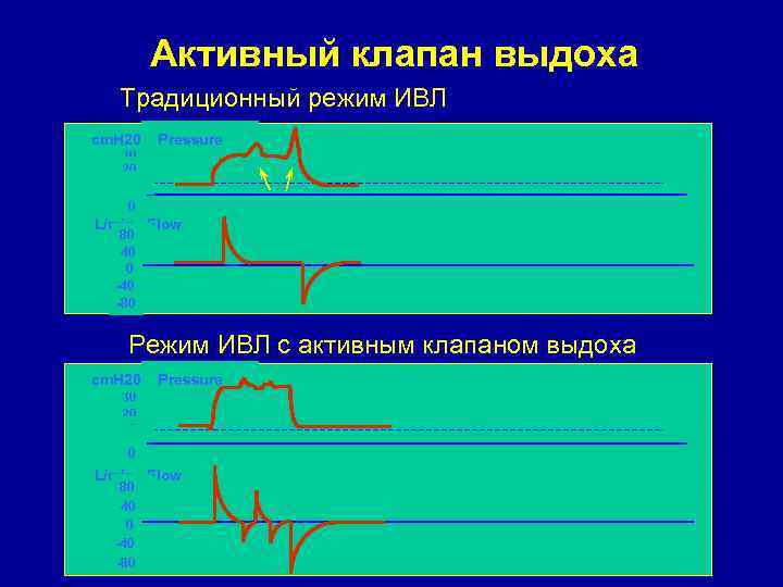 Активный клапан выдоха Традиционный режим ИВЛ cm. H 20 30 20 10 Pressure 0
