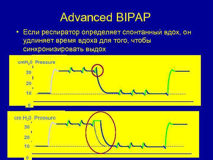Advanced BIPAP • Если респиратор определяет спонтанный вдох, он удлиняет время вдоха для того,