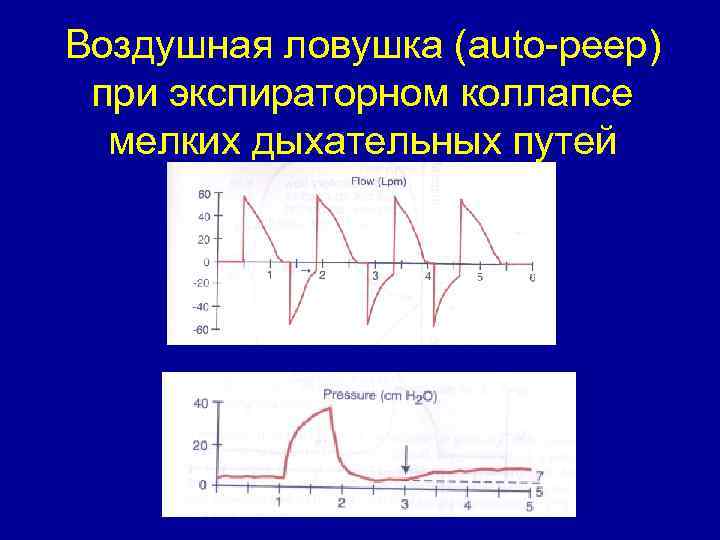 Воздушная ловушка (auto-peep) при экспираторном коллапсе мелких дыхательных путей 