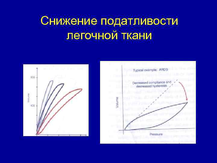 Снижение податливости легочной ткани 