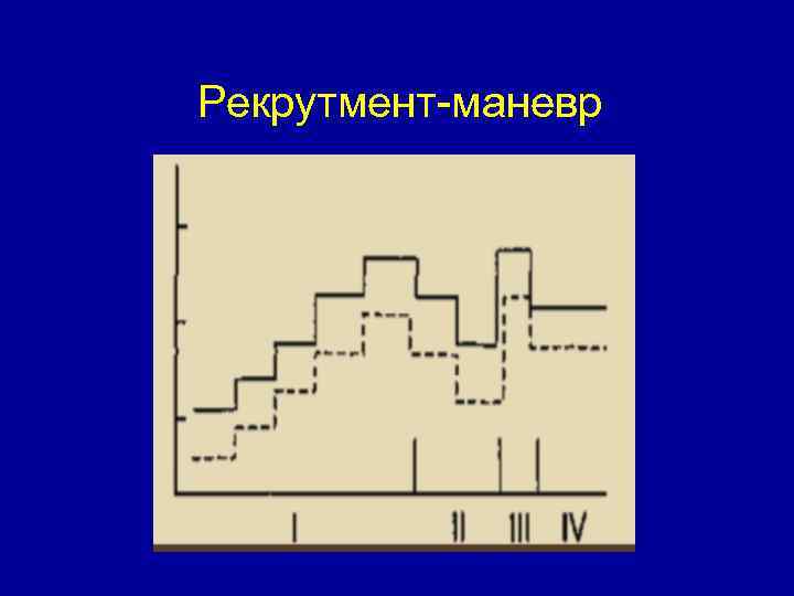 Рекрутмент-маневр 