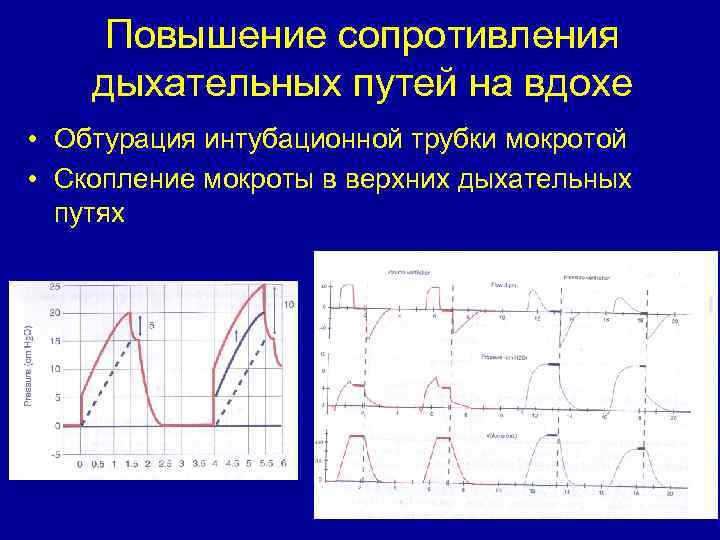 Повышение сопротивления дыхательных путей на вдохе • Обтурация интубационной трубки мокротой • Скопление мокроты